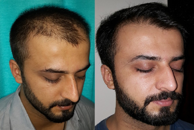 hair-transplant-before-after.jpg