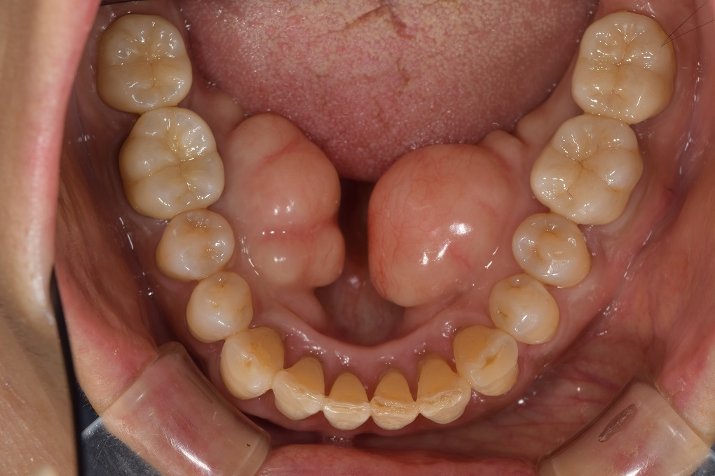 歯の再治療。 - 片岡歯科紺屋町診療所ブログ